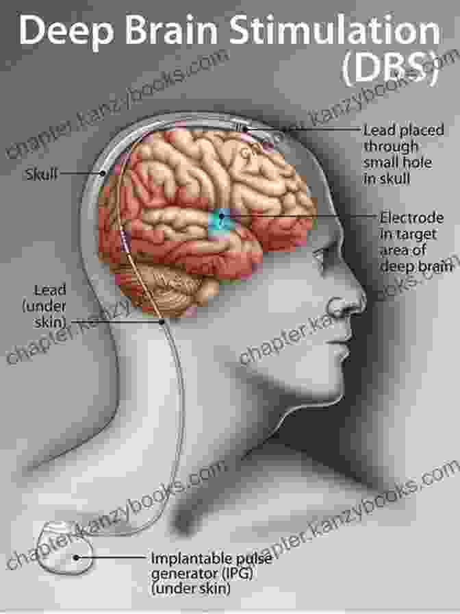 A Diagram Illustrating Deep Brain Stimulation For Parkinson's Disease Surgical Options : A Treatment Guide To Parkinson S Disease